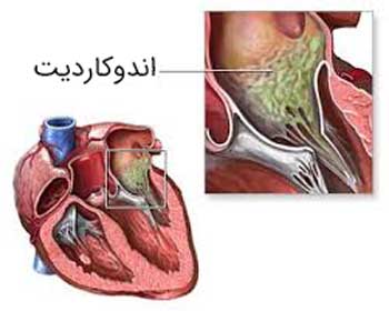 بیماری اندوکاردیت عفونی (Endocarditis) - علل , علائم , تشخیص و درمان