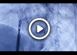 ویدئو بستن asd کودک 4 ساله با روش آنژیوگرافی