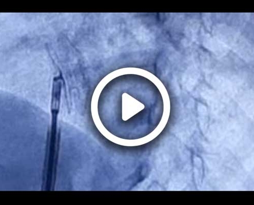 ویدئو بستن asd کودک 4 ساله با روش آنژیوگرافی