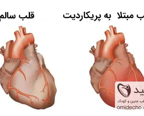 پریکاردیت چیست؟ | علائم، پیشگیری و درمان