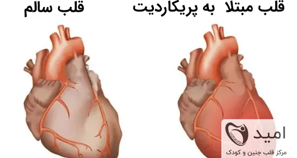 پریکاردیت چیست؟ | علائم، پیشگیری و درمان